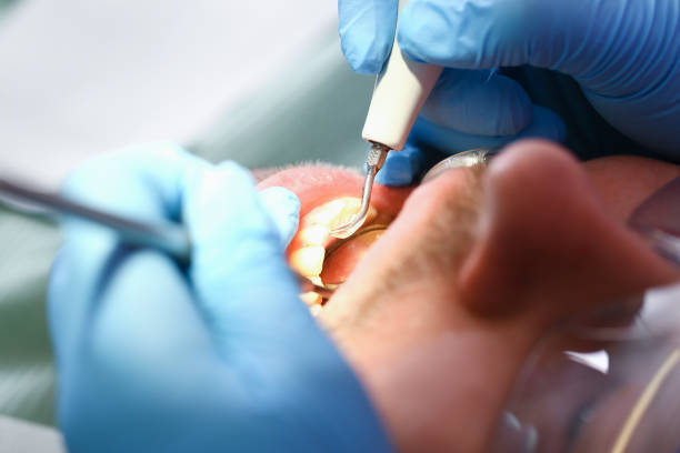 Best Emergency Wisdom Teeth Removal in Blakely, PA