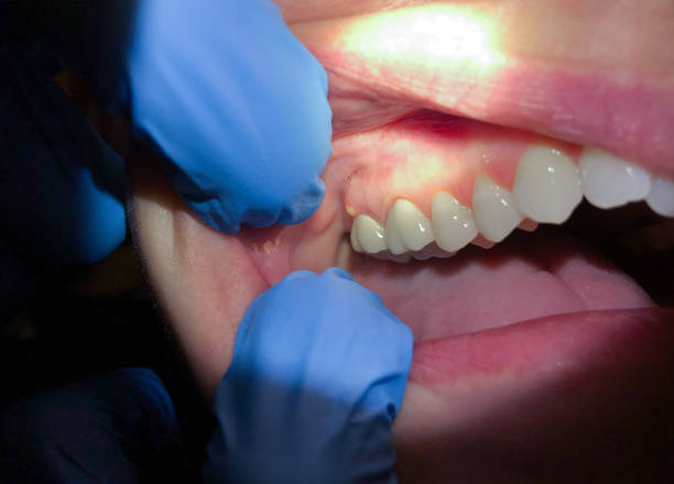 Best Emergency Broken Tooth Repair in Blakely, PA